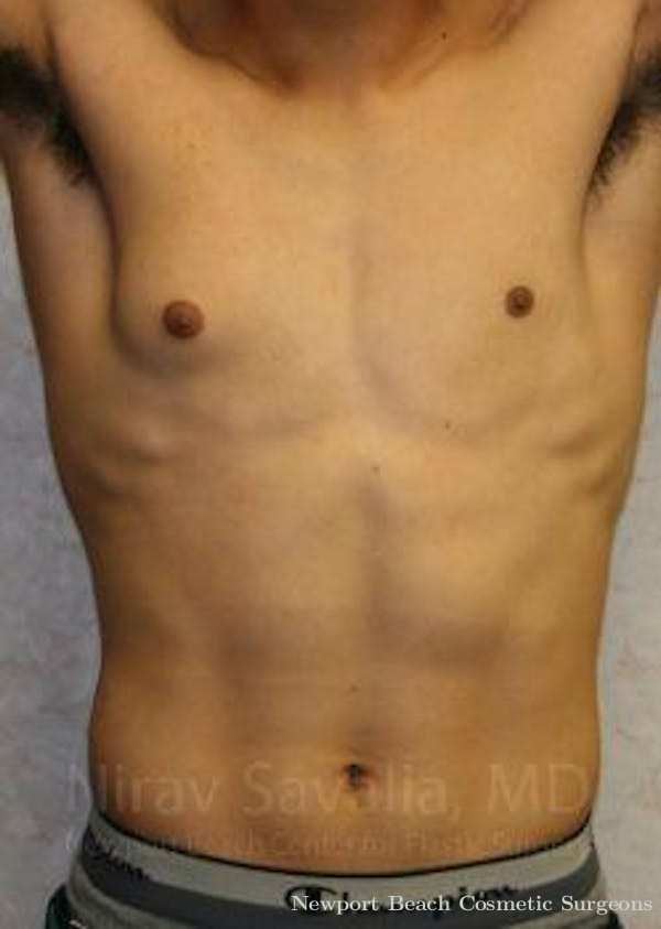 Male Breast Reduction Before & After Gallery - Patient 1655607 - Before