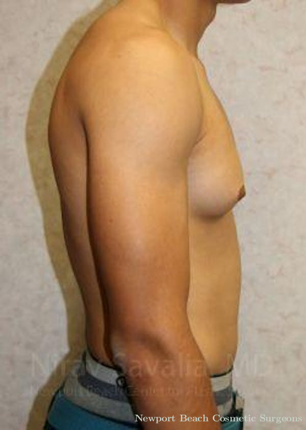 Mastectomy Reconstruction Revision Before & After Gallery - Patient 1655607 - Before