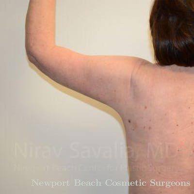 Breast Reduction Before & After Gallery - Patient 1655606 - After