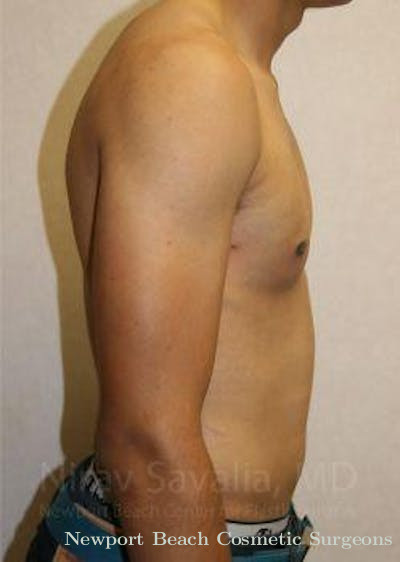 Mastectomy Reconstruction Before & After Gallery - Patient 1655607 - After