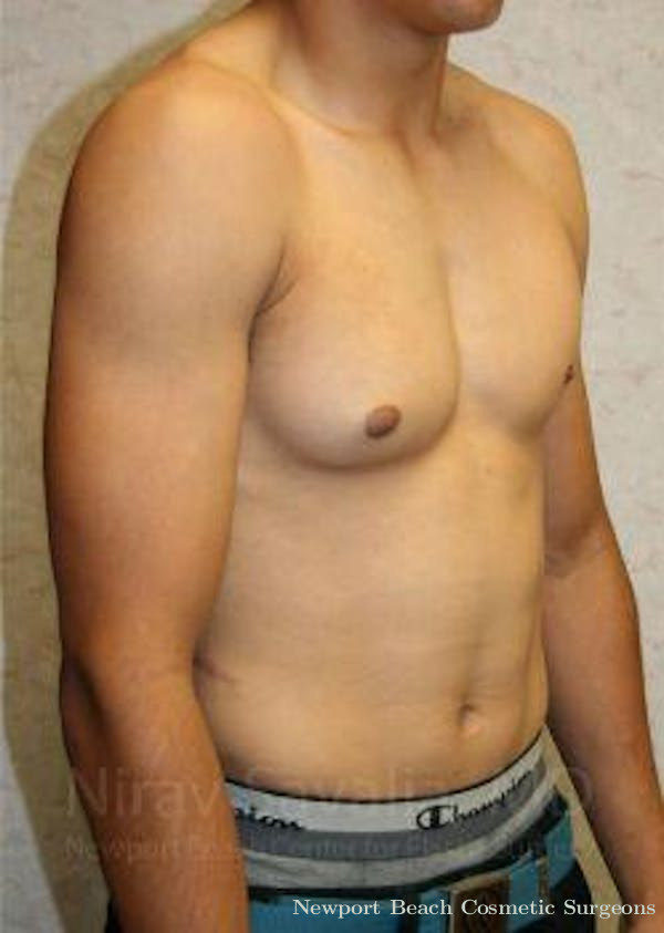 Breast Reduction Before & After Gallery - Patient 1655607 - Before