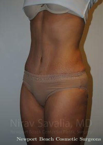 Breast Implant Revision Before & After Gallery - Patient 1655608 - After