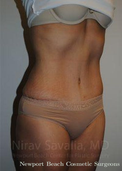 Thigh Lift Before & After Gallery - Patient 1655608 - After