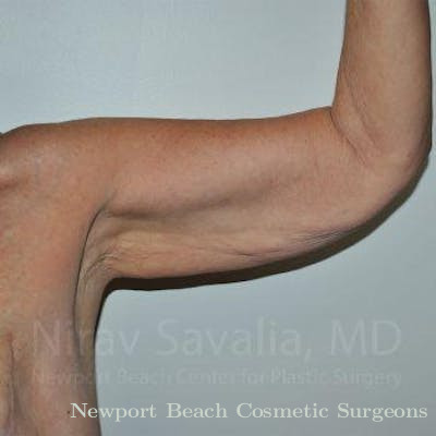 Breast Explantation En Bloc Capsulectomy Before & After Gallery - Patient 1655610 - Before