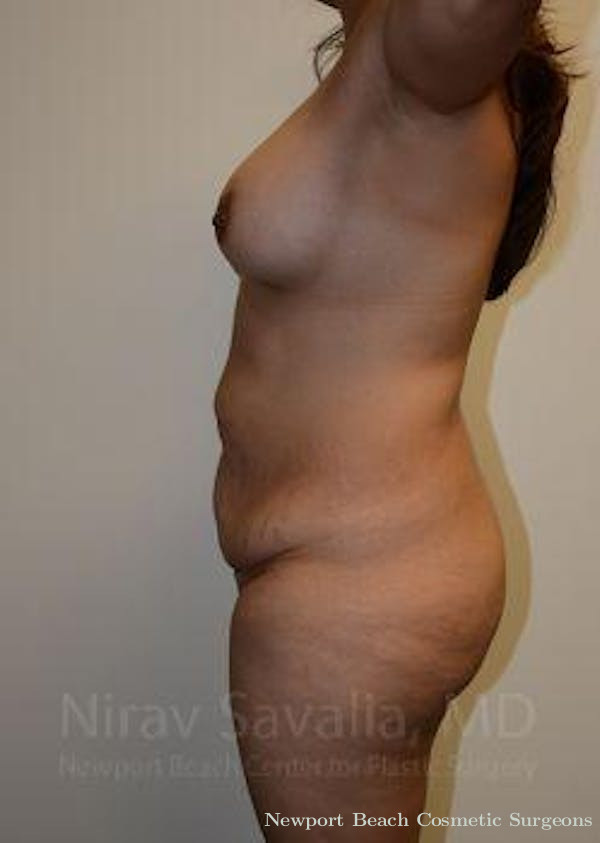 Mastectomy Reconstruction Revision Before & After Gallery - Patient 1655609 - Before