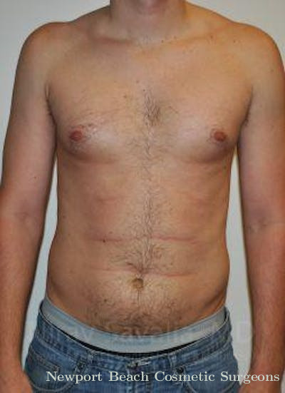 Male Breast Reduction Before & After Gallery - Patient 1655612 - Before