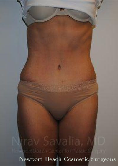 Thigh Lift Before & After Gallery - Patient 1655611 - After
