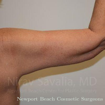 Mastectomy Reconstruction Before & After Gallery - Patient 1655610 - After