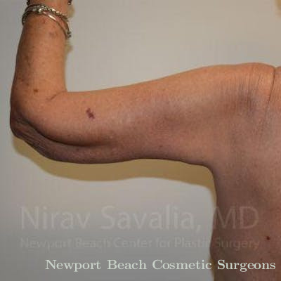 Arm Lift Before & After Gallery - Patient 1655610 - After