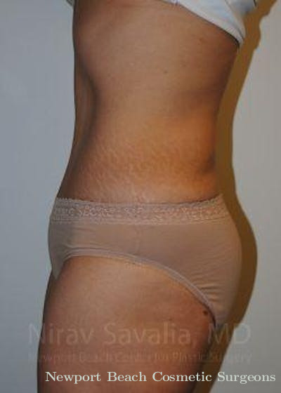 Liposuction Before & After Gallery - Patient 1655611 - After
