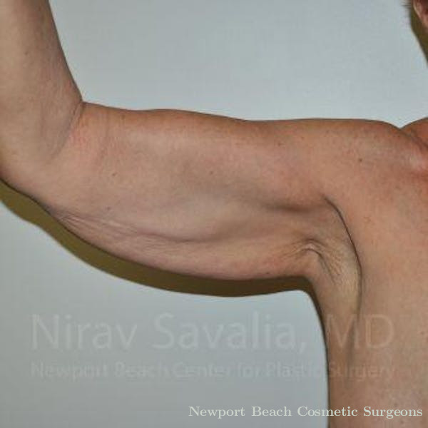 Breast Explantation En Bloc Capsulectomy Before & After Gallery - Patient 1655610 - Before