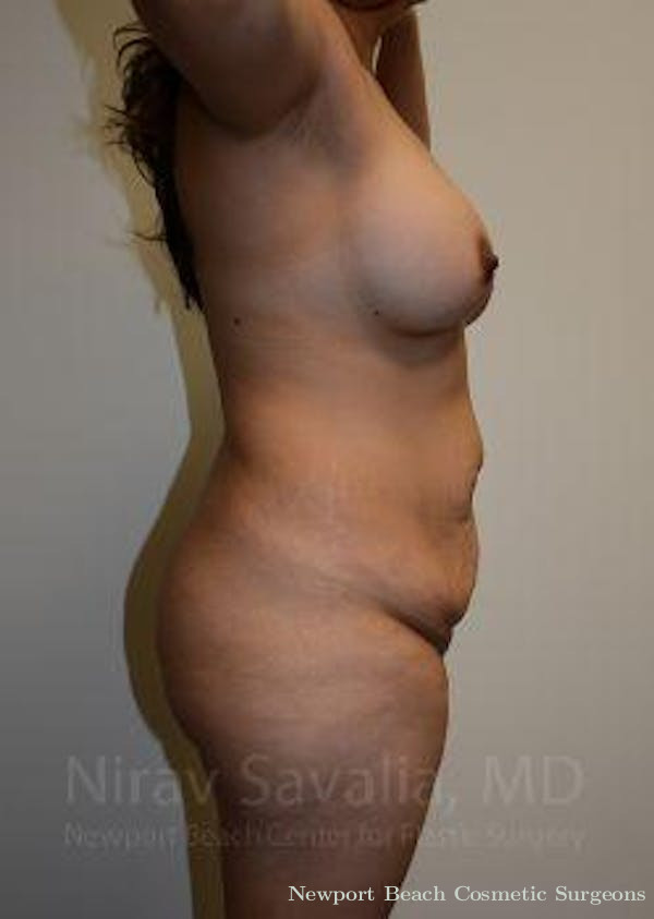 Mastectomy Reconstruction Revision Before & After Gallery - Patient 1655613 - Before