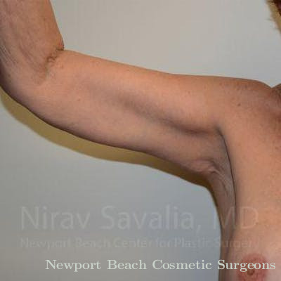 Mastectomy Reconstruction Revision Before & After Gallery - Patient 1655610 - After
