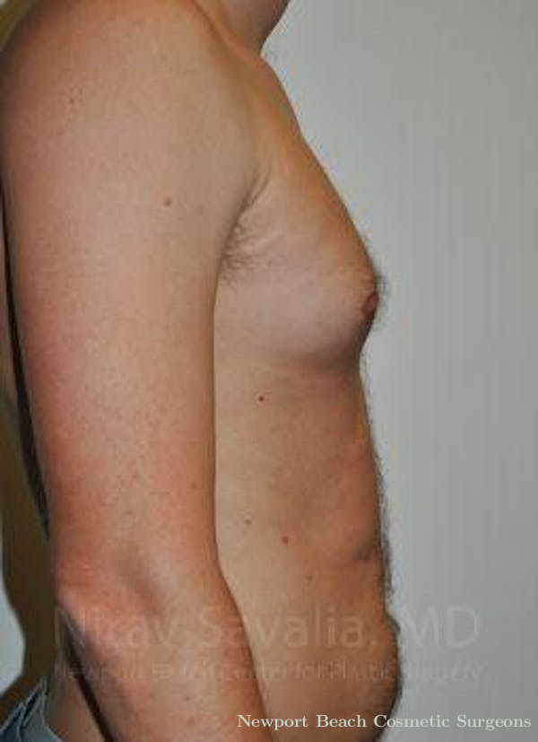 Male Breast Reduction Before & After Gallery - Patient 1655612 - Before