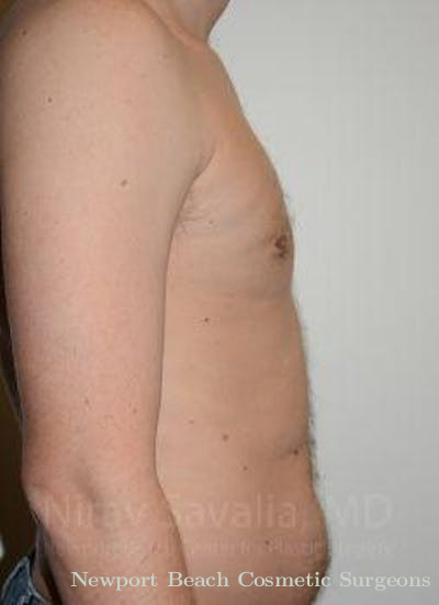 Male Breast Reduction Before & After Gallery - Patient 1655612 - After