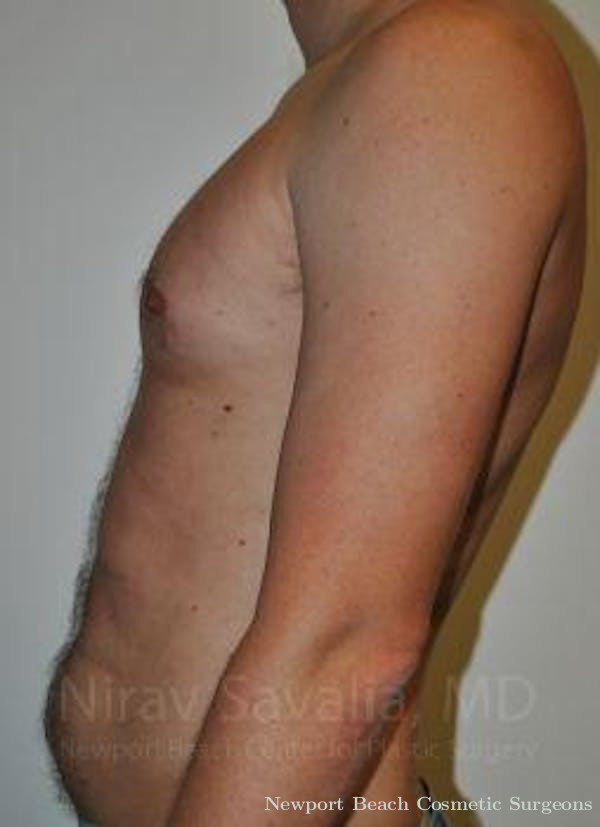 Oncoplastic Reconstruction Before & After Gallery - Patient 1655612 - Before