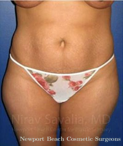 Abdominoplasty Tummy Tuck Before & After Gallery - Patient 1655614 - Before