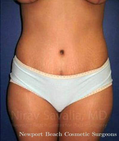 Liposuction Before & After Gallery - Patient 1655614 - After