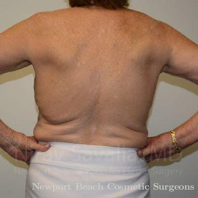 Mastectomy Reconstruction Before & After Gallery - Patient 1655616 - Before