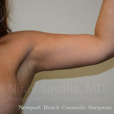 Liposuction Before & After Gallery - Patient 1655615 - After