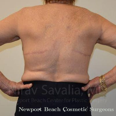 Facelift Before & After Gallery - Patient 1655616 - After