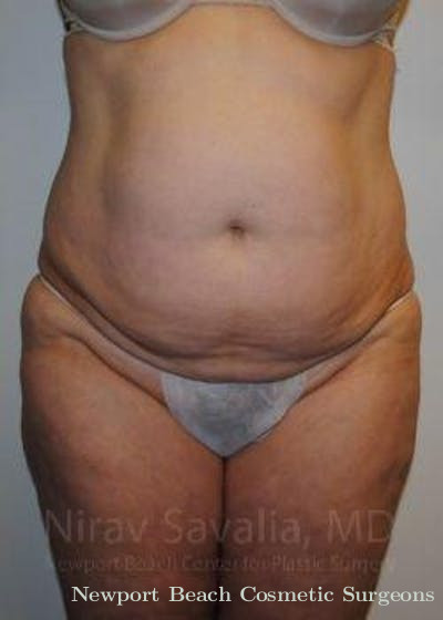 Abdominoplasty Tummy Tuck Before & After Gallery - Patient 1655617 - Before