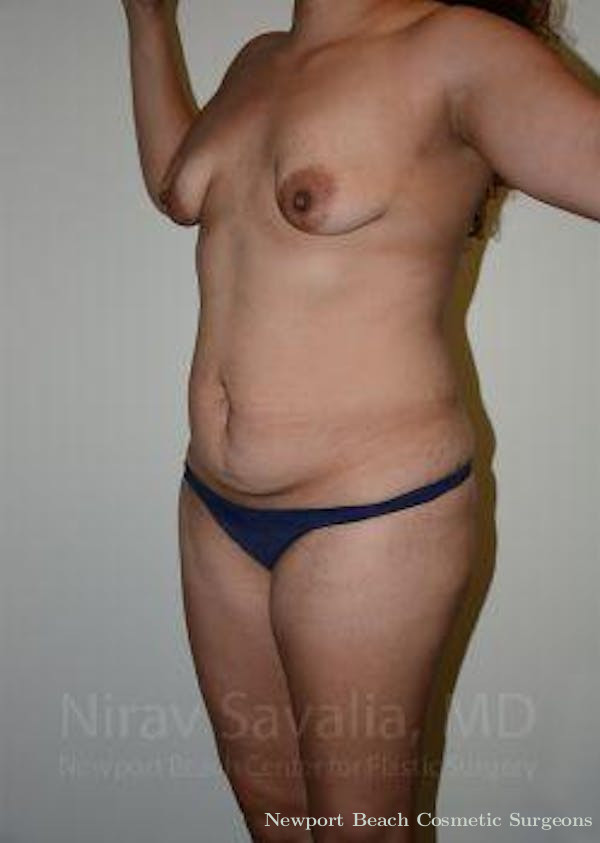Breast Lift without Implants Before & After Gallery - Patient 1655619 - Before