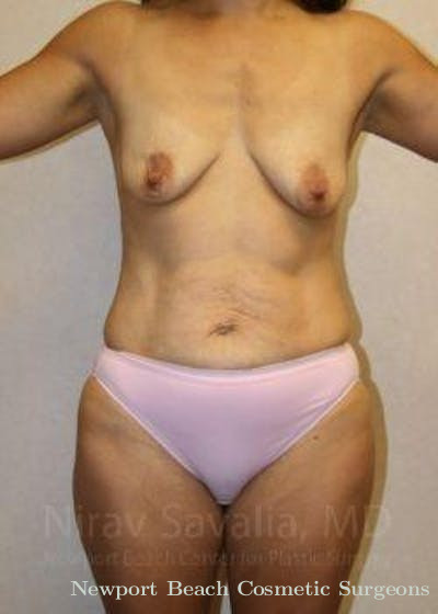 Breast Explantation En Bloc Capsulectomy Before & After Gallery - Patient 1655621 - Before