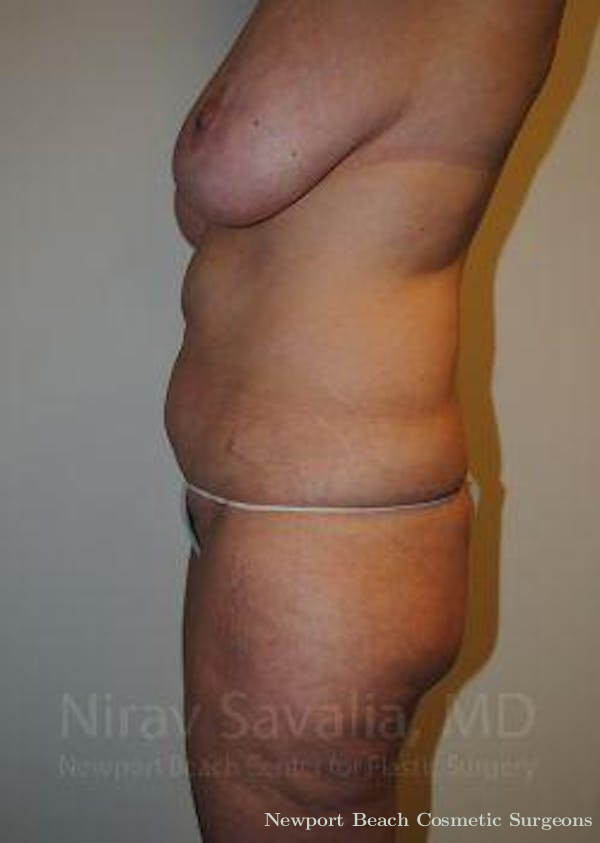 Mastectomy Reconstruction Before & After Gallery - Patient 1655623 - Before