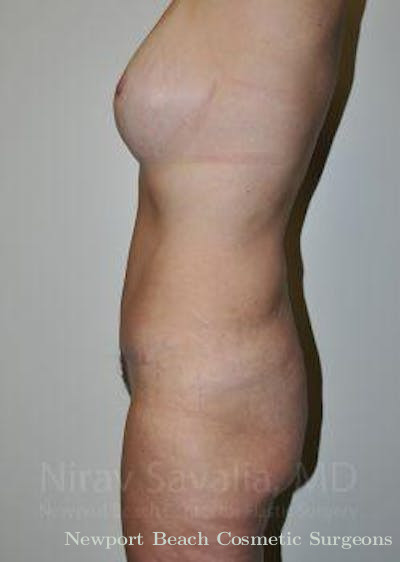 Oncoplastic Reconstruction Before & After Gallery - Patient 1655623 - After