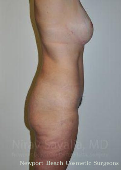 Mastectomy Reconstruction Revision Before & After Gallery - Patient 1655623 - After