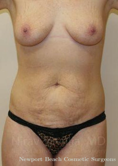 Oncoplastic Reconstruction Before & After Gallery - Patient 1655627 - Before