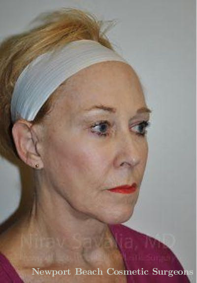 Eyelid Surgery Before & After Gallery - Patient 1655625 - Before