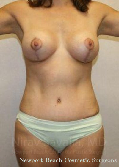 Mastectomy Reconstruction Revision Before & After Gallery - Patient 1655626 - After