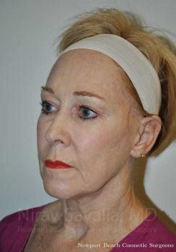 Facelift Before & After Gallery - Patient 1655625 - Before