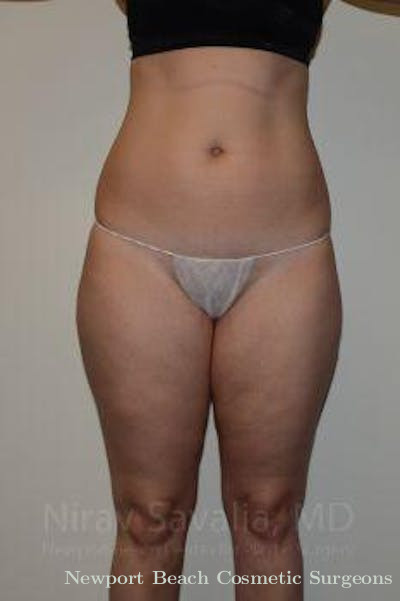 Mastectomy Reconstruction Revision Before & After Gallery - Patient 1655629 - Before