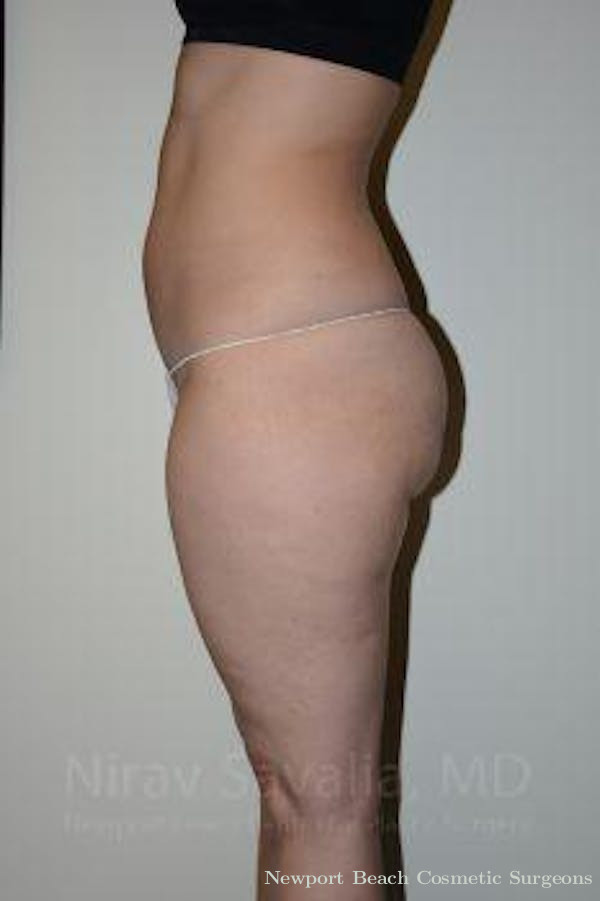 Abdominoplasty Tummy Tuck Before & After Gallery - Patient 1655629 - Before