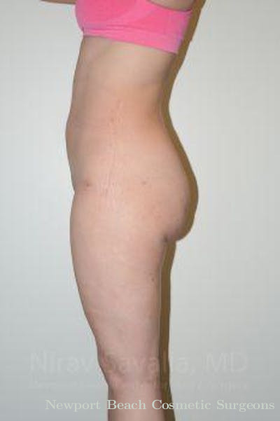 Abdominoplasty Tummy Tuck Before & After Gallery - Patient 1655629 - After