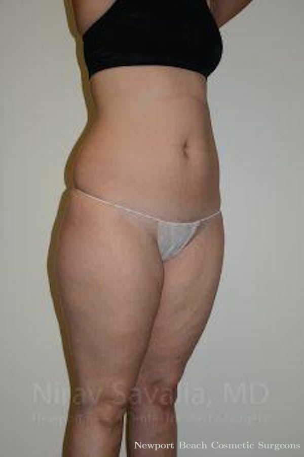 Oncoplastic Reconstruction Before & After Gallery - Patient 1655629 - Before