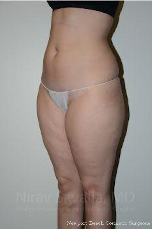 Body Contouring after Weight Loss Before & After Gallery - Patient 1655629 - Before