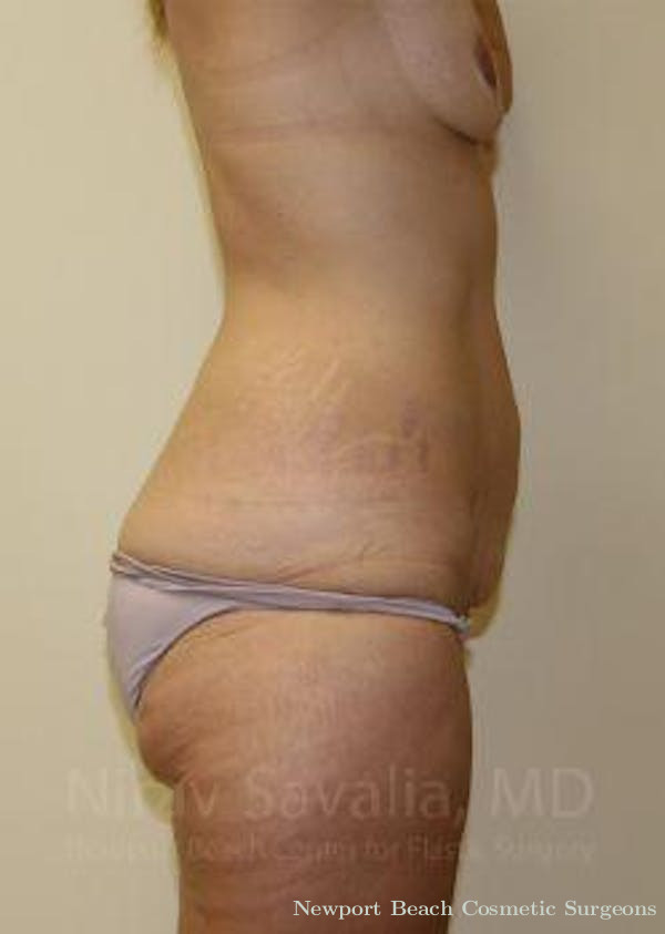 Oncoplastic Reconstruction Before & After Gallery - Patient 1655631 - Before