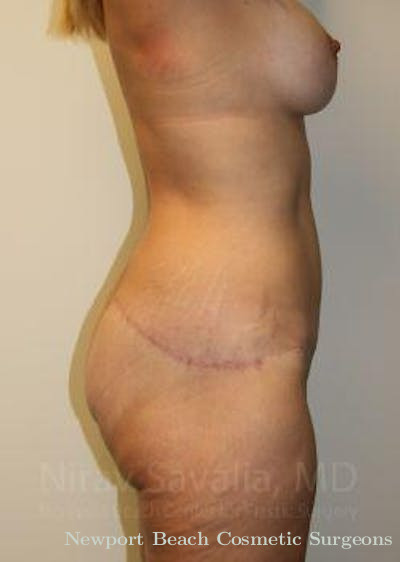 Breast Lift with Implants Before & After Gallery - Patient 1655631 - After