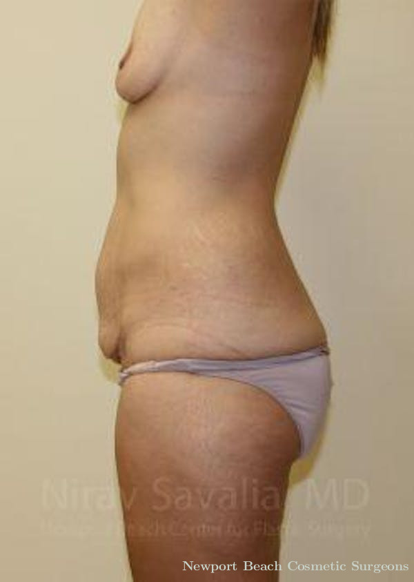 Liposuction Before & After Gallery - Patient 1655630 - Before