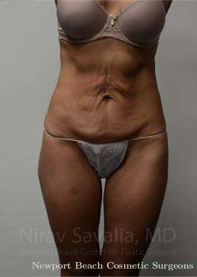 Mastectomy Reconstruction Revision Before & After Gallery - Patient 1655633 - Before
