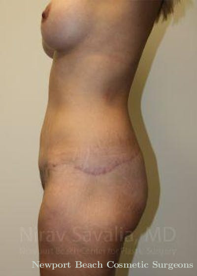 Breast Explantation En Bloc Capsulectomy Before & After Gallery - Patient 1655630 - After