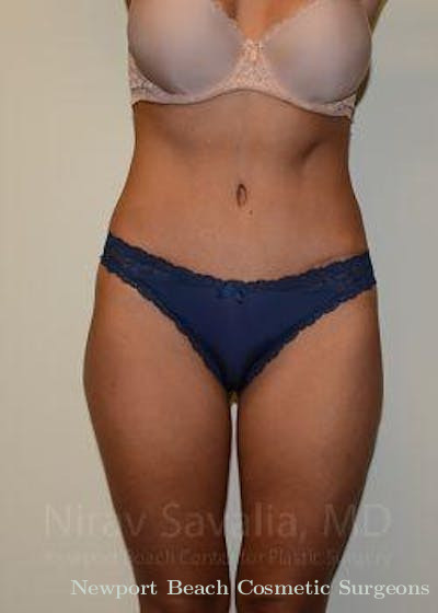 Liposuction Before & After Gallery - Patient 1655633 - After