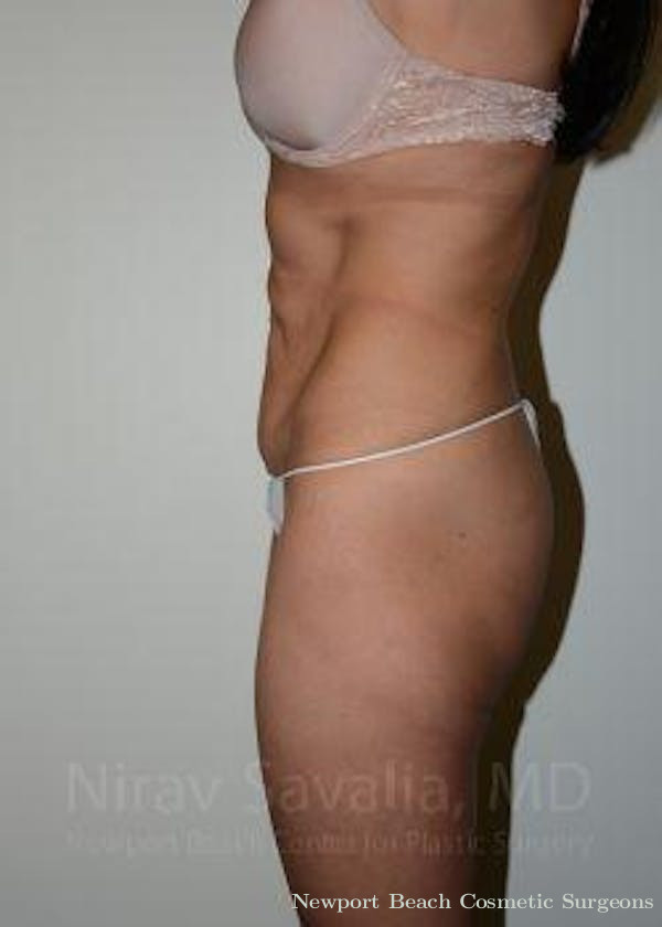 Liposuction Before & After Gallery - Patient 1655633 - Before