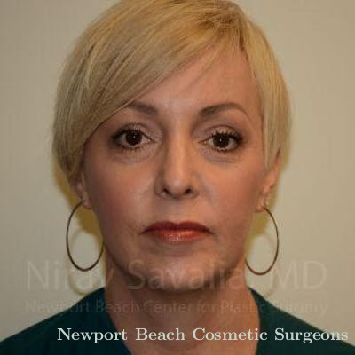 Breast Augmentation Before & After Gallery - Patient 1655632 - Before