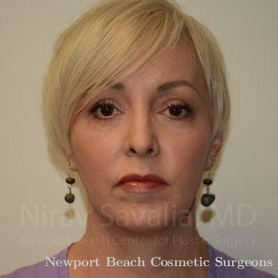 Breast Implant Revision Before & After Gallery - Patient 1655632 - After