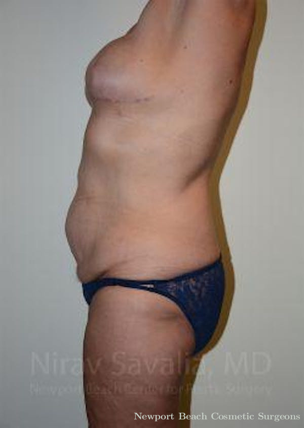 Thigh Lift Before & After Gallery - Patient 1655634 - Before